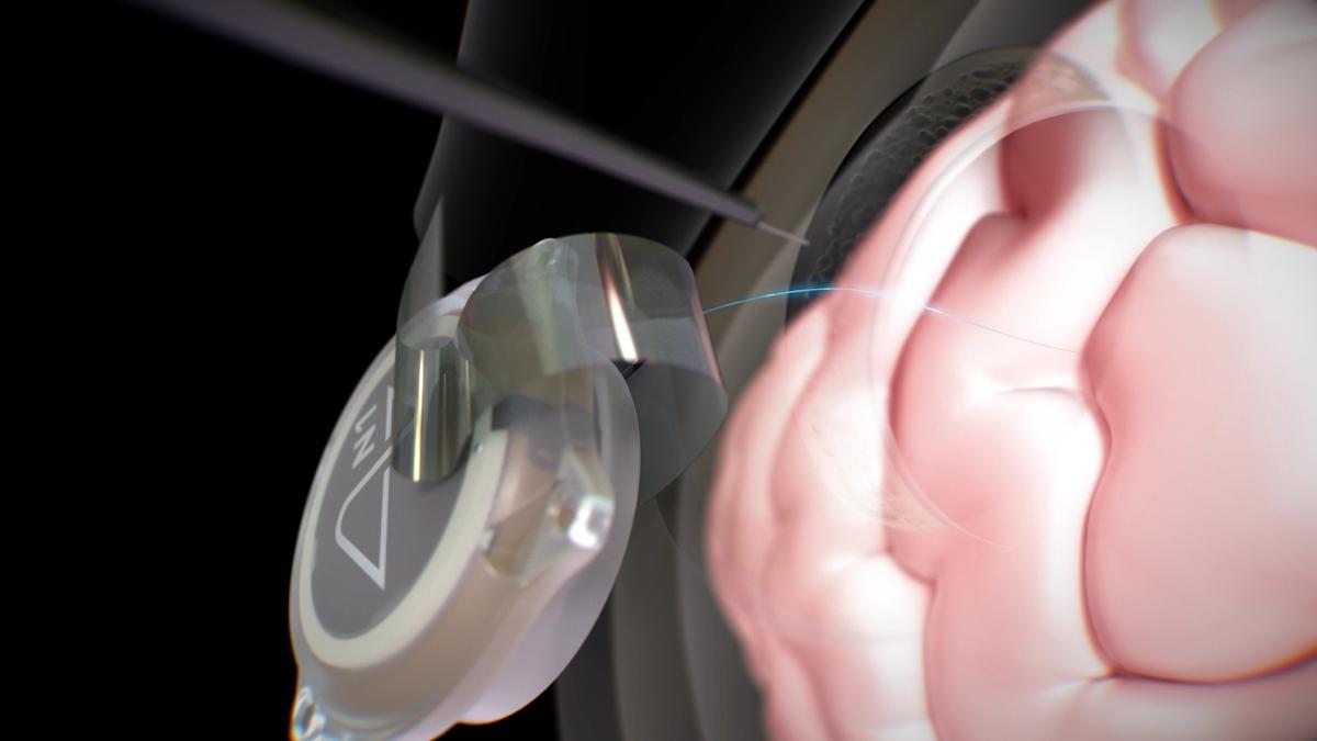 Neuralink VOICE Trial Patient's Thought-to-Speech Video Goes Viral with 40M Views